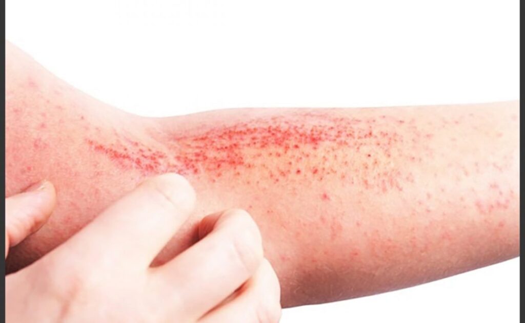 Conoce Los Distintos Tipos De Dermatitis Notiboom Noticias Al Momento